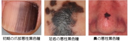 皮膚がんは増えている 関西ろうさい病院 兵庫県尼崎市 地域医療支援病院 がん診療連携拠点病院