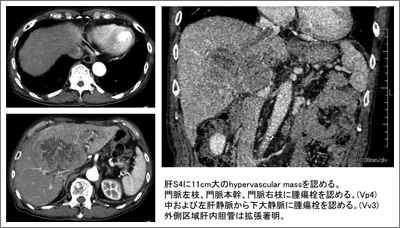 肝癌 | 関西ろうさい病院（兵庫県尼崎市）地域医療支援病院・がん診療 