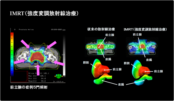 放射線治療装置