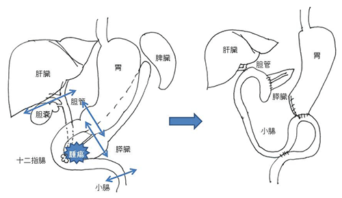 図1　膵頭十二指腸切除術