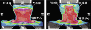 IMRT②