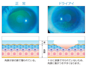 ドライアイ②