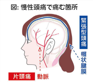 慢性の頭痛②