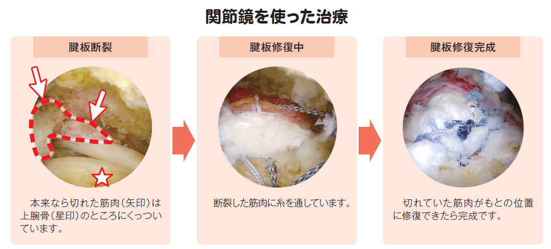 腱板断裂に対する関節鏡視下手術② | 関西ろうさい病院（兵庫県尼崎市