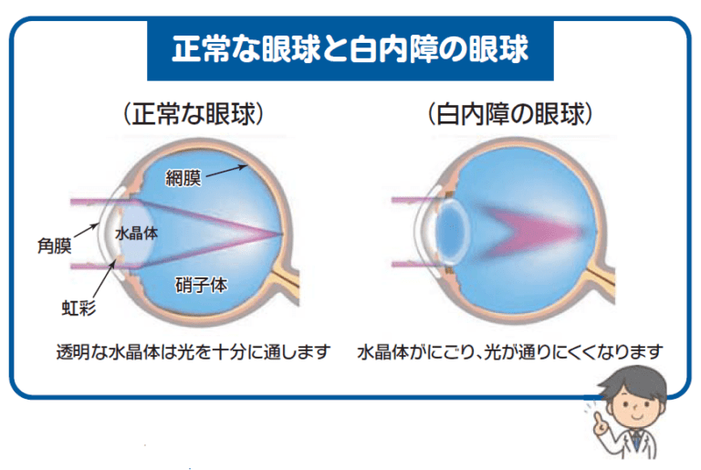 白内障について知っておくべきことすべて！
