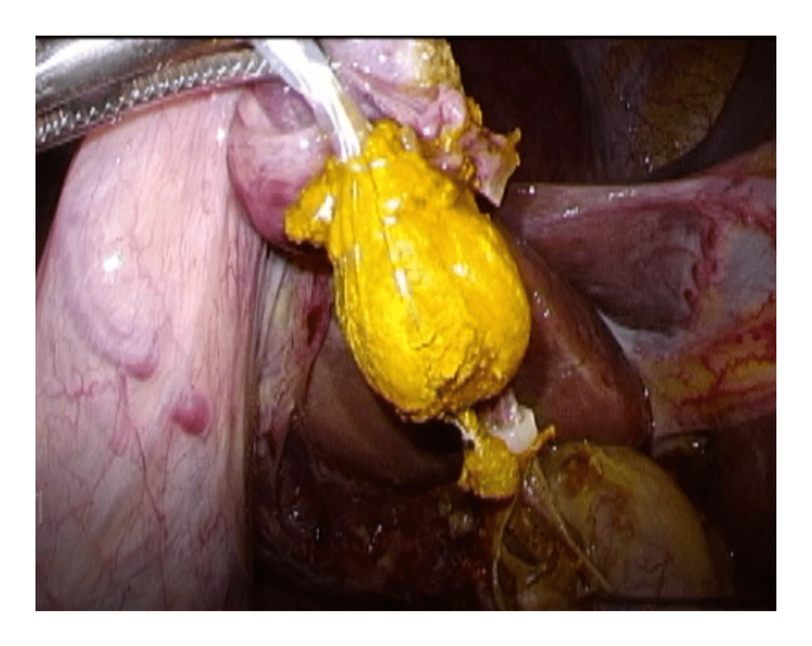 図5　腹腔鏡下総胆管切開切石術（結石摘出）
