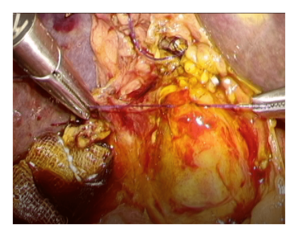 図6　腹腔鏡下総胆管切開切石術（胆管縫合）