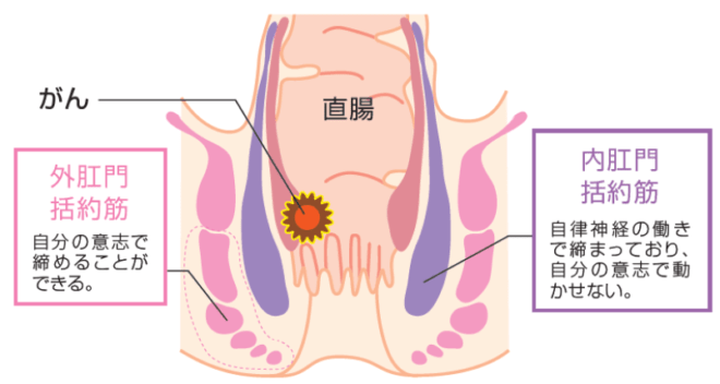 術前　術後　病院　大阪　ISR 肛門温存　仕事　就労支援　大腸癌　大腸がん　結腸癌　結腸がん　直腸癌　直腸がん　コロレクくん　ロボット手術　大阪　消化器外科　ランキング　腹腔鏡手術　低侵襲　おすすめ　名医