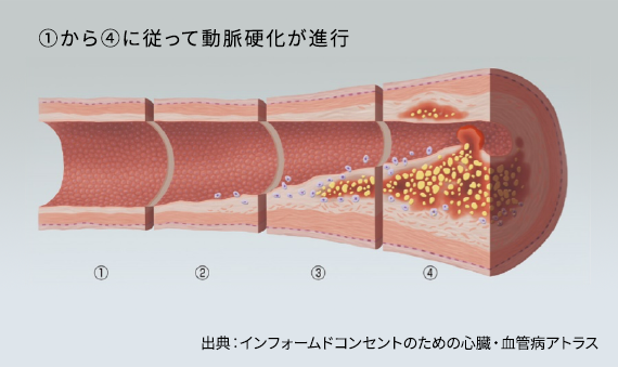 心筋 梗塞 カテーテル 手術