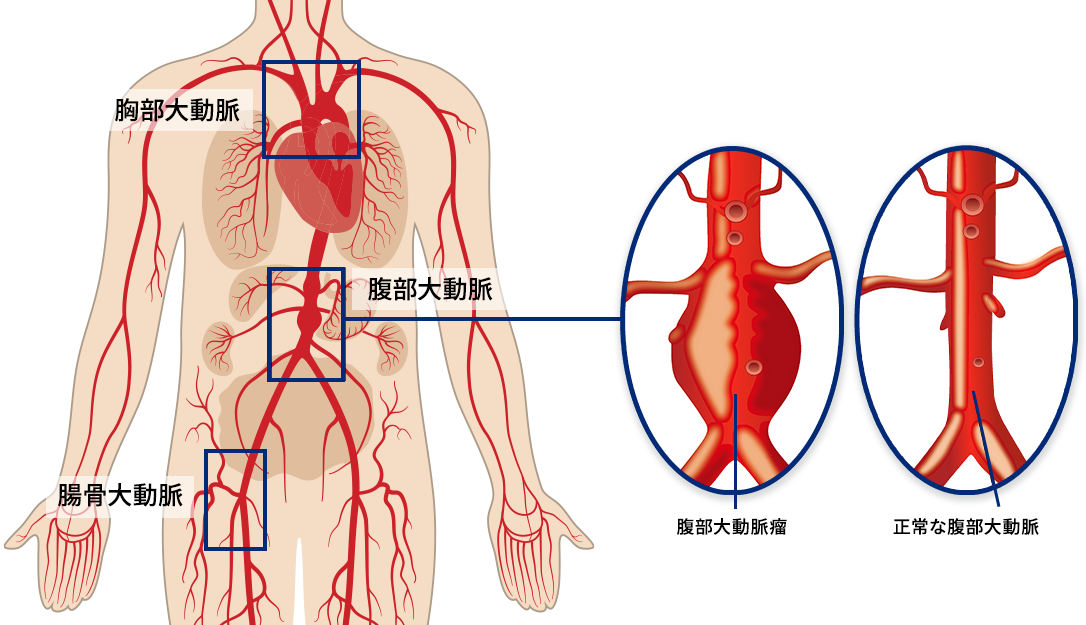 症状 腹部 大動脈 瘤