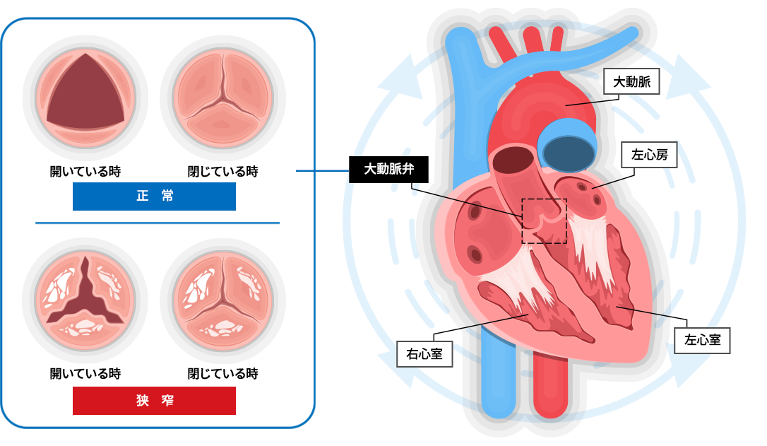 大動脈弁狭窄症があると低血圧が起こりますか?
