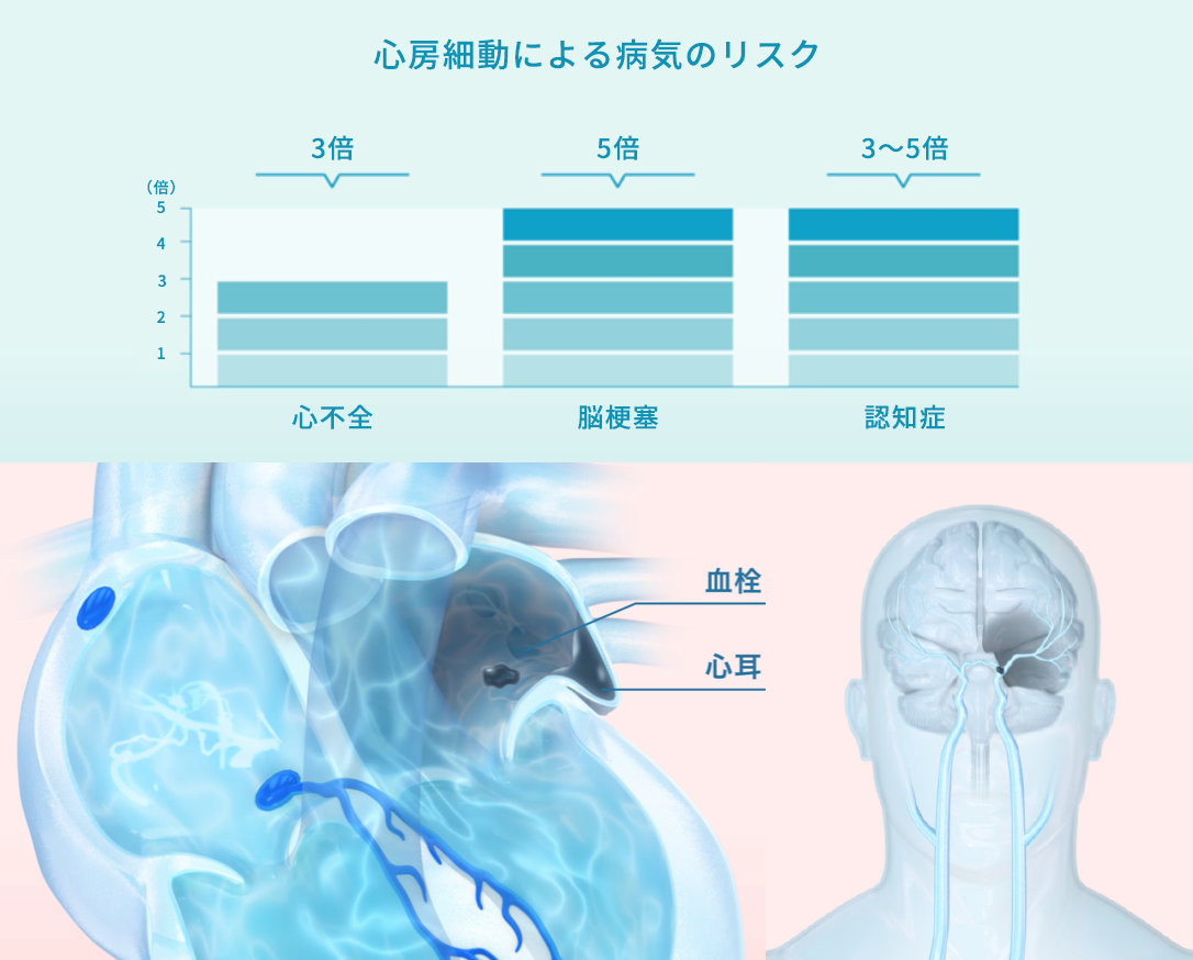 アブレーション は カテーテル と