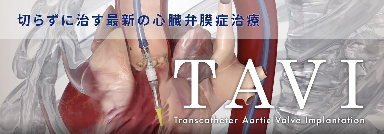 切らずに治す最新の心臓弁膜症治療 –TAVI：Transcatheter Aortic Valve Implantation（タビ）とは？