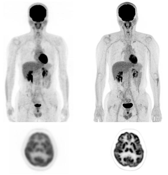 新旧PET-CT画像を比較しています。