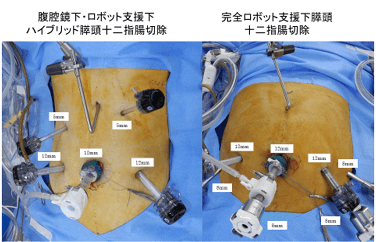 図4. ロボット支援腹腔鏡下膵頭十二指腸切除のポート配置