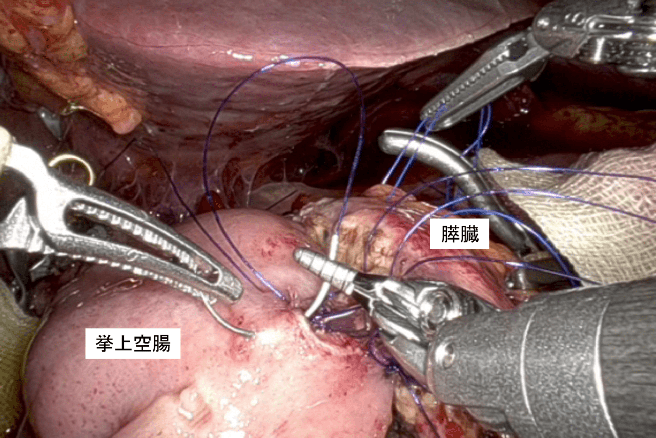 図5.ロボット支援腹腔鏡下膵頭十二指腸切除（膵管空腸吻合）

