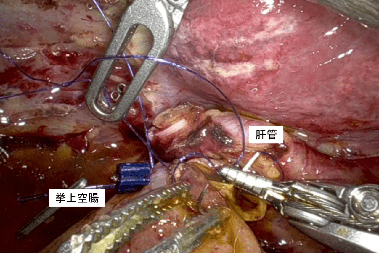 図6.ロボット支援腹腔鏡下膵頭十二指腸切除（肝管空腸吻合）
