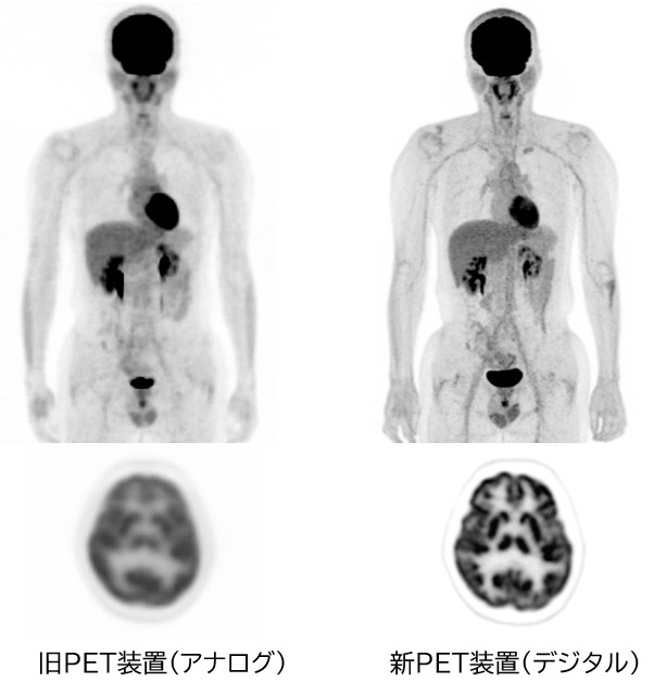 新旧PET装置による画像(全身MIP像および頭部axial像)